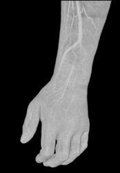 CTA of the Hand Using VRT and MIP - CTisus CT Scan