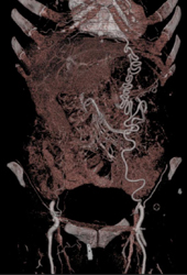 Extensive Collaterals With Diseased Aorta - CTisus CT Scan