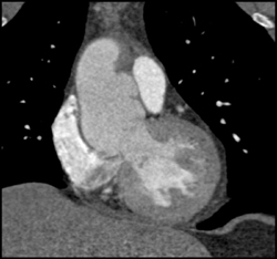 Dilated Aortic Root - CTisus CT Scan