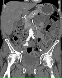 Right External Iliac Aneurysm - CTisus CT Scan