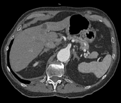 Dissection Involves SMA - CTisus CT Scan