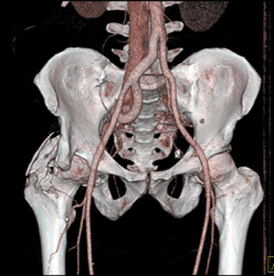 Arteriovenous (AV) Fistulae With Early Filling of IVC - CTisus CT Scan