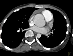 Dilated Aortic Root - CTisus CT Scan