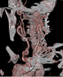 Tortuous Carotid Aa in Loeys-Dietz Syndrome - CTisus CT Scan