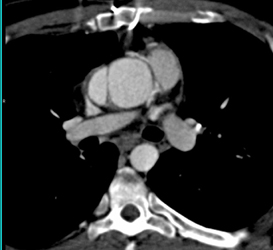 Type A Dissection at Aortic Root - CTisus CT Scan