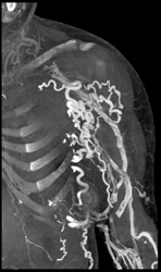 Extensive Collaterals Left Axilla and Chest Wall - CTisus CT Scan