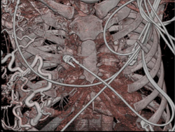 Collaterals in Axilla - CTisus CT Scan