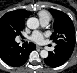 SVC Clot With Focal Dissection Off Ascending Aorta - CTisus CT Scan