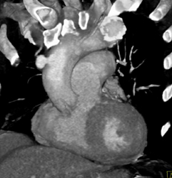 Repair of Aortic Aneurysm - CTisus CT Scan