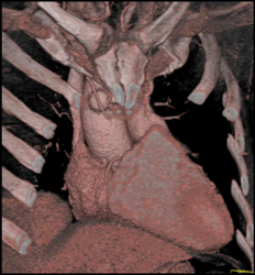 Coronary Artery Bypass Graft (CABG) Post Repair - CTisus CT Scan