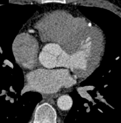 Stent in LAD - CTisus CT Scan