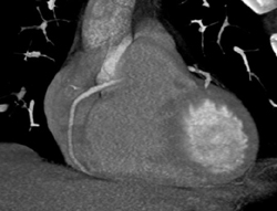 Stent in LAD - CTisus CT Scan