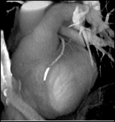 Stent in LAD - CTisus CT Scan