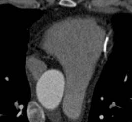 Stent in LAD - CTisus CT Scan