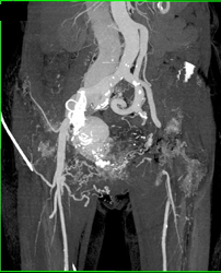 Right Internal Iliac Artery Aneurysm With Coiling and Arteriovenous (AV) Fistulae - CTisus CT Scan