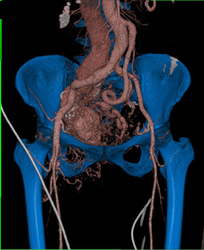 Automating Bone Editing to Better Define Vascular Anatomy - CTisus CT Scan