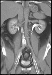 Inferior Vena Cava (IVC) Stents - CTisus CT Scan