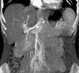 Transjugular Intrahepatic Portosystemic Shunt (TIPS) With Hepatic Artery Pseudoaneurysm - CTisus CT Scan