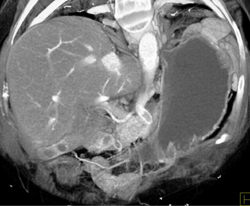 Clot in Celiac Axis - CTisus CT Scan