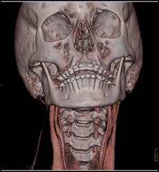 Normal Carotid Aa and Jugular Vein - CTisus CT Scan