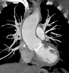 Aortic Valve Replacement (AVR) With Dilated Ascending Aorta - CTisus CT Scan