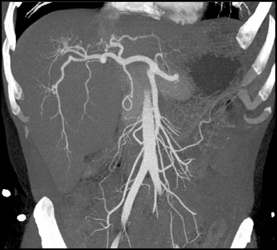 Stretched Hepatic Artery By Liver Mass - CTisus CT Scan