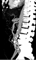 Stenosis Celiac of SMA - CTisus CT Scan