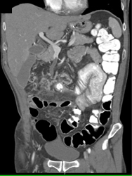 Clot in Superior Mesenteric Vein (SMV) - CTisus CT Scan