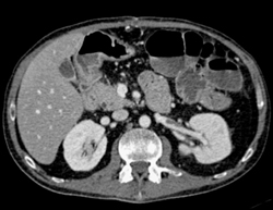 Clot in Left Renal Vein - CTisus CT Scan