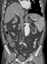 Left Renal Aa Aneurysm - CTisus CT Scan