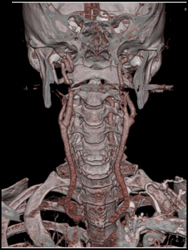 Artifact Off Fillings Cause Pseudo-stenosis - CTisus CT Scan