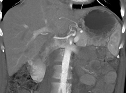 Left Gastric Artery - CTisus CT Scan