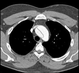 Type B Dissection - CTisus CT Scan