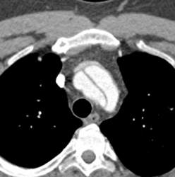 Type B Dissection - CTisus CT Scan