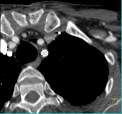 Stent in Left Subclavian Aa - CTisus CT Scan