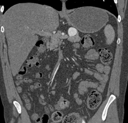 Splenic Artery Aneurysm - CTisus CT Scan