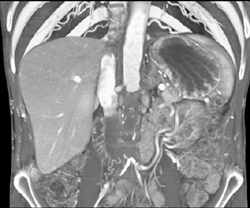 Aortic Occlusion With Collaterals - CTisus CT Scan