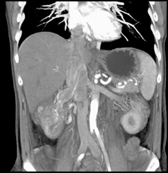 Renal Cell Carcinoma Invades the Right Renal Vein and IVC and Into Right Atrium - CTisus CT Scan