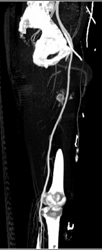 GSW With Bleed From Superficial Femoral Artery (SFA) - CTisus CT Scan