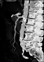 SMA of Celiac Aa Off A Common Trunk - CTisus CT Scan