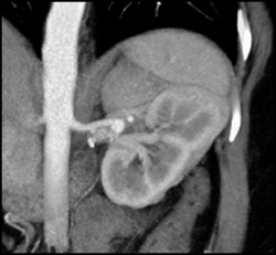 Renal Aa Aneurysm - CTisus CT Scan