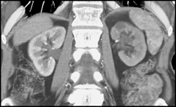 Left Renal Aa Stenosis With Delayed Enhancement of the Kidney - CTisus CT Scan