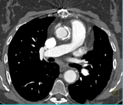 Aortic Valve Replacement - CTisus CT Scan