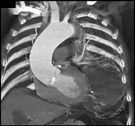 Dilated Aortic Root and Ascending Aorta - CTisus CT Scan