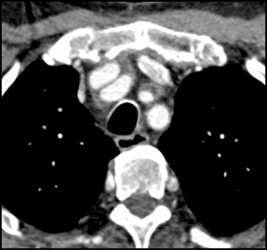 Takayasu's Arteritis - CTisus CT Scan