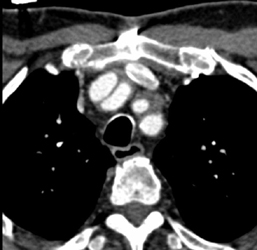 Takayasu's Arteritis - CTisus CT Scan