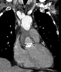 Dissection Extends Into Right Innominate Aa - CTisus CT Scan