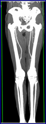 Runoff Study With Diseased Left Popliteal and Trifurcation Vessels - CTisus CT Scan