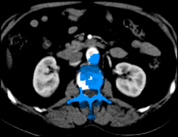 Poor Bone Editing Easily Adjusted From Aorta - CTisus CT Scan