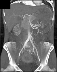 Vasculitis- Loeys-Dietz - CTisus CT Scan